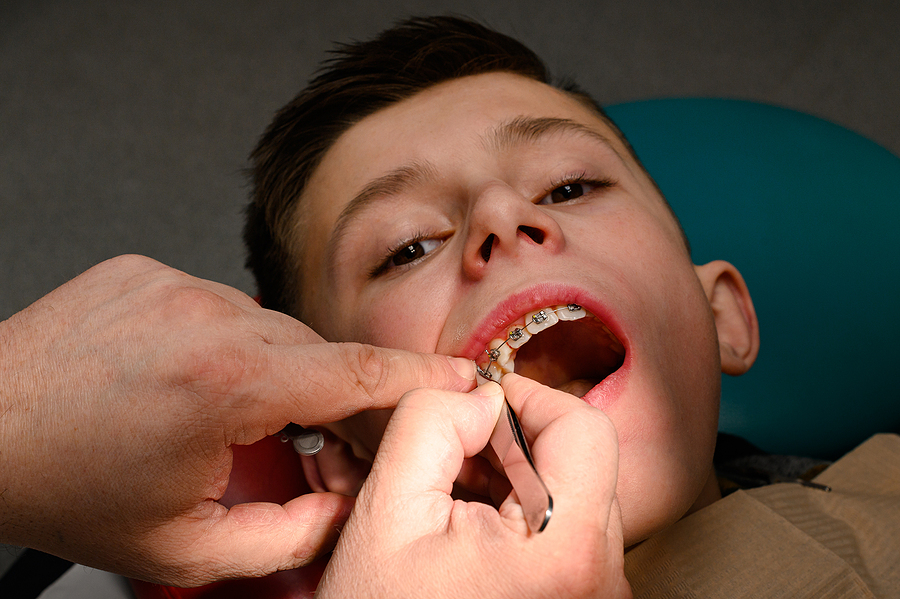 An Orthodontist Glues And Fastens Braces On The Upper Teeth Of A